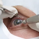 Eye Surgery