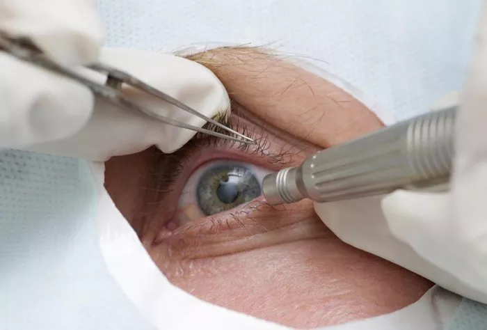 Eye Surgery