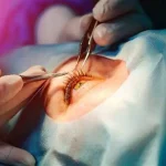 Eye surgery