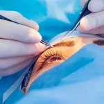 Eye surgery7