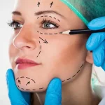 Facial surgery