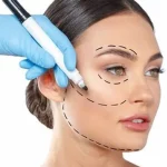 Facial surgery