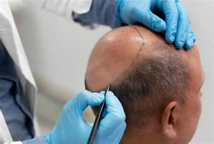 Hair Transplant