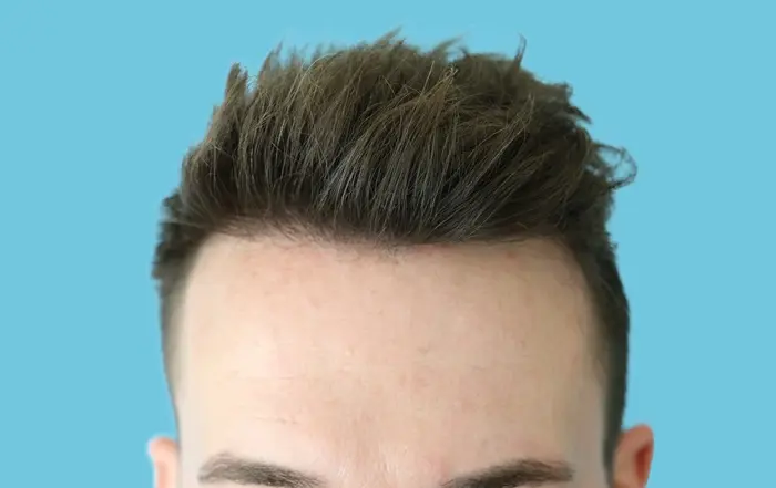 Hair Transplant