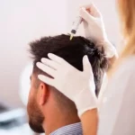 Hair Transplant