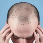 Hair Transplant4