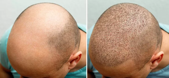 Hair Transplant5