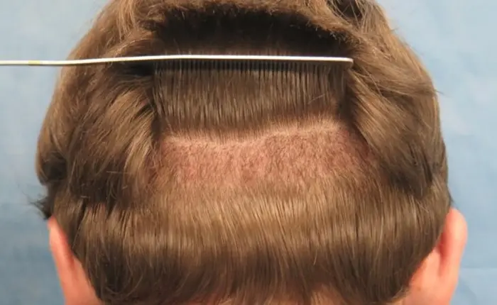 Hair Transplant5