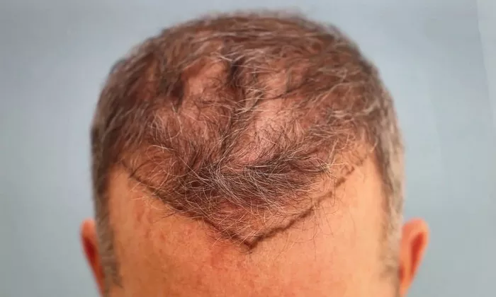 Hair Transplant6