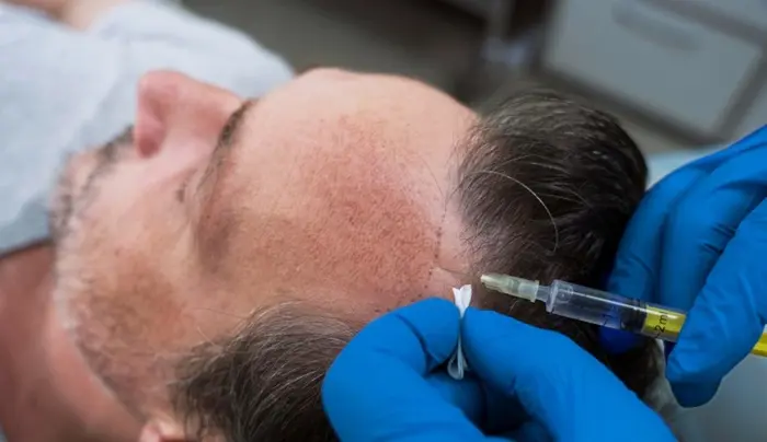 Hair Transplant6