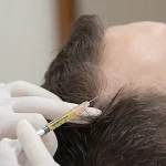 Hair Transplant7