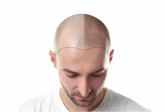 Hair Transplant8