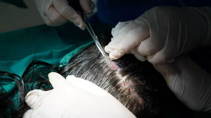 Hair Transplant9