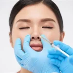 Rhinoplasty