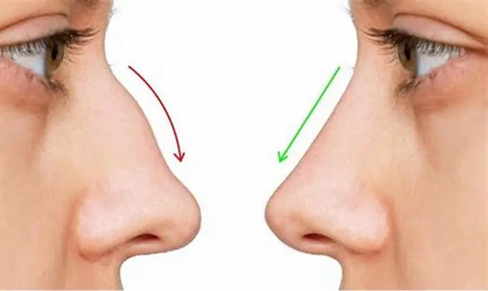 Rhinoplasty