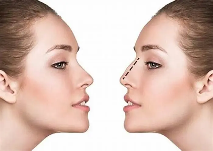 Rhinoplasty8