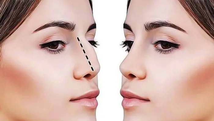 Rhinoplasty9