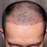 Hair Transplant