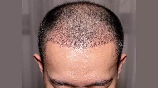 Hair Transplant