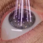 Eye Surgery15