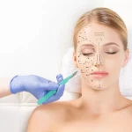 Facial surgery