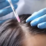 Hair Transplant25