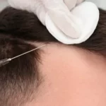 Hair Transplant8