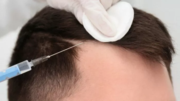 Hair Transplant8