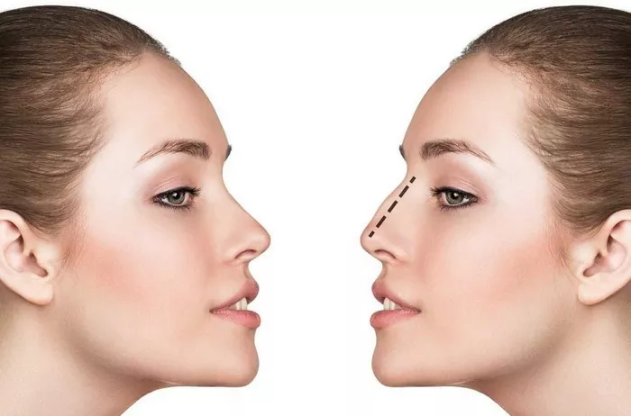 Rhinoplasty18