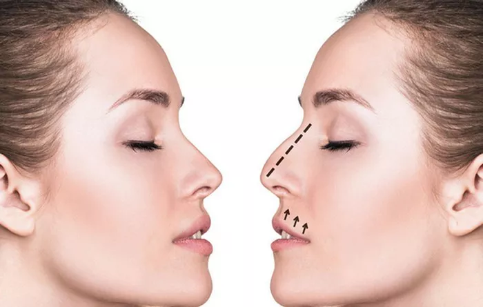 Rhinoplasty20