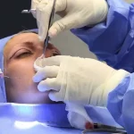 Rhinoplasty9