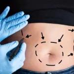 tummy tuck