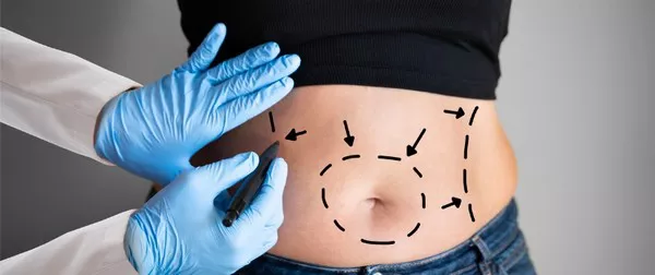 tummy tuck