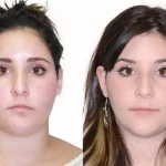 Facial Asymmetry Surgery