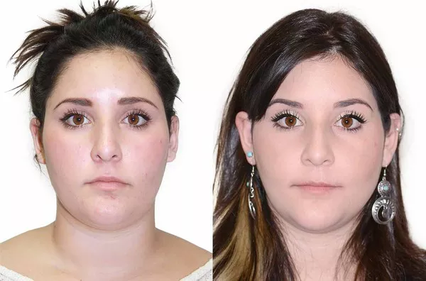 Facial Asymmetry Surgery